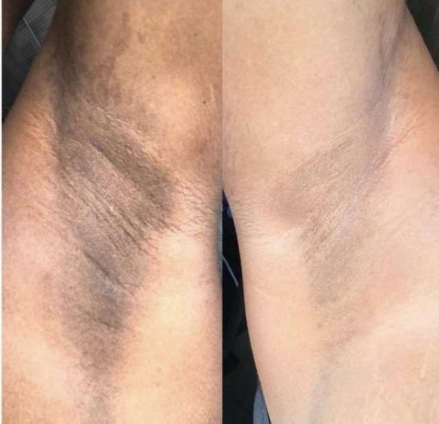 ✨ Épilation laser : bien plus que des poils en moins ✨

Sur cette photo, le résultat que tu vois est APRÈS épilation laser 👆

💡 Beaucoup pensent que le laser sert uniquement à éliminer les poils…
Mais en réalité, il fait bien plus que ça 👇

✔️ Diminution des poils
✔️ Moins de poils sous peau
✔️ Moins d’irritations et de rasage
✔️ Peau plus nette et plus uniforme
✔️ Atténuation de l’hyperpigmentation liée aux poils et aux frottements

👉 Quand les agressions répétées (rasoir, cire, inflammation) disparaissent,
la peau a enfin le temps de se réparer et de retrouver une couleur plus homogène ✨

📌 Chaque peau réagit différemment, c’est pourquoi un diagnostic gratuit est toujours réalisé avant de commencer.

📲 Rendez-vous pour diagnostic gratuit
Lien Planity dans la bio 🤍
#
#epilationlaser #laserfemme #aisselles #hyperpigmentation peaulisse
peauuniforme avantapres institutdebeaute laserlyon diagnosticgratuit