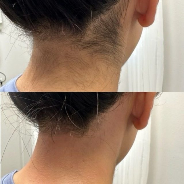 Notre blog Épilation laser nouvelle génération ✨
Une peau plus douce dès les premières séances 🤍 Notre laser nouvelle génération est équipé d’un embout froid pour un traitement confortable et pratiquement indolore. Les premiers résultats peuvent être visibles dès la 1ʳᵉ séance.
En moyenne, il faut prévoir 6 à 10 séances, généralement espacées de 4 à 8 semaines, selon la zone, le type de poil et votre cycle de pousse.
⚠️ Certaines contre-indications existent : grossesse, certains traitements médicamenteux, peau récemment bronzée, certaines maladies ou lésions cutanées… C’est pourquoi un diagnostic préalable est important.
🎁 Diagnostic offert à l’institut
Prenez votre RDV dès maintenant — lien en bio.