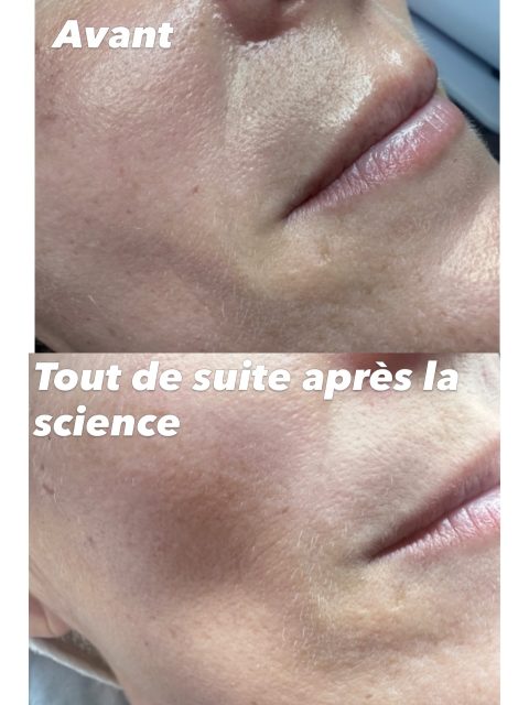 Notre blog ✨ Radiofréquence – Déroulement et résultats
La radiofréquence est un soin qui aide à améliorer l’aspect et la fermeté de la peau. Pour obtenir de meilleurs résultats, il est conseillé d’effectuer 1 à 2 séances par semaine, selon les besoins et la zone traitée.
⏱️ Durée d’une séance : environ 1 heure
💶 Prix à la séance : 80 €
✨ Forfait 4 séances : 300 €
Les résultats évoluent progressivement au fil des séances. Un programme adapté sera conseillé en fonction de l’objectif recherché.
prise de rendez-vous sur Planity, le lien en bio